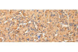 Immunohistochemistry of paraffin-embedded Human liver cancer tissue using AQP7 Polyclonal Antibody at dilution 1:40 (Aquaporin 7 antibody)