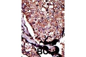 Formalin-fixed and paraffin-embedded human cancer tissue reacted with the primary antibody, which was peroxidase-conjugated to the secondary antibody, followed by DAB staining. (DGKB antibody  (C-Term))