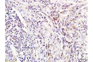Formalin-fixed and paraffin embedded human colon carcinoma labeled with Rabbit Anti NGAL/Lipocalin 2 Polyclonal Antibody, Unconjugated (ABIN685627) at 1:200 followed by conjugation to the secondary antibody and DAB staining (Lipocalin 2 antibody  (AA 101-198))
