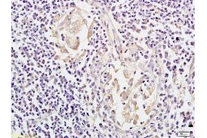 Formalin-fixed and paraffin embedded: human colon carcinoma labeled with Anti-Mesothelin Polyclonal Antibody, Unconjugated  at 1:200, followed by conjugation to the secondary antibody and DAB staining (Mesothelin antibody  (AA 101-200))