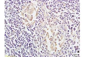 Formalin-fixed and paraffin embedded: human colon carcinoma labeled with Anti-Mesothelin Polyclonal Antibody, Unconjugated  at 1:200, followed by conjugation to the secondary antibody and DAB staining (Mesothelin antibody  (AA 101-200))