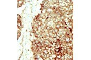 Formalin-fixed and paraffin-embedded human cancer tissue reacted with the primary antibody, which was peroxidase-conjugated to the secondary antibody, followed by DAB staining. (FGFR2 antibody  (C-Term))