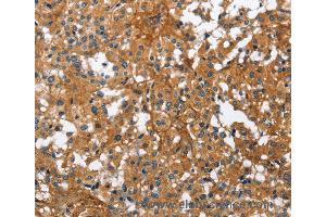 Immunohistochemistry of Human liver cancer using BGN Polyclonal Antibody at dilution of 1:50 (Biglycan antibody)