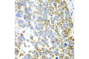 Immunohistochemistry of paraffin-embedded human esophageal cancer using CHIA antibody. (CHIA antibody)