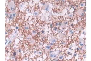 Detection of TDH in Human Glioma Tissue using Polyclonal Antibody to L-Threonine Dehydrogenase (TDH) (Tdh antibody  (AA 1-229))