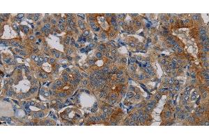 Immunohistochemistry of paraffin-embedded Human thyroid cancer tissue using PER2 Polyclonal Antibody at dilution 1:50 (PER2 antibody)