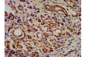 IHC image of ABIN7157616 diluted at 1:400 and staining in paraffin-embedded human pancreatic cancer performed on a Leica BondTM system. (KIF2B antibody  (AA 1607-1731))