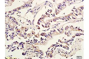 Formalin-fixed and paraffin embedded human colon cancer labeled with Anti Amphiregulin Polyclonal Antibody, Unconjugated (ABIN704996) at 1:600 followed by conjugation to the secondary antibody and DAB staining