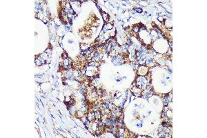 Immunohistochemistry of paraffin-embedded Human colon carcinoma using T Rabbit pAb (ABIN7266436) at dilution of 1:100 (40x lens). (TACO1 antibody  (AA 1-297))