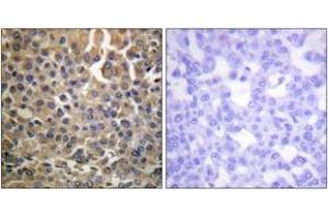 Immunohistochemistry analysis of paraffin-embedded human breast carcinoma, using HER4 (Phospho-Tyr1284) Antibody. (ERBB4 antibody  (pTyr1284))