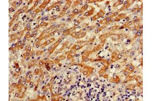 Immunohistochemistry of paraffin-embedded human liver cancer using ABIN7144848 at dilution of 1:100 (ATP5F1D antibody  (AA 23-168))