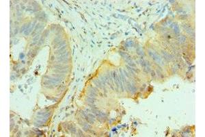 Immunohistochemistry of paraffin-embedded human colon cancer using ABIN7147105 at dilution of 1:100 (CNOT8 antibody  (AA 1-292))