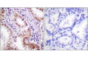 Immunohistochemistry analysis of paraffin-embedded human lung carcinoma tissue, using Histone H3 (Ab-9) Antibody. (Histone 3 antibody  (AA 1-50))