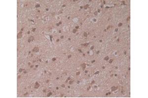 IHC-P analysis of Human Glioma Tissue, with DAB staining. (ENPP2 antibody  (AA 637-905))