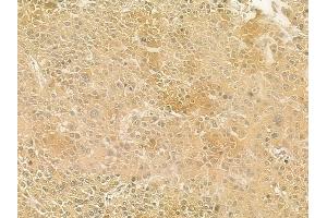 ABIN6258485 and ABIN6275808 at 1/100 staining human hepatocellular carcinoma by IHC-P.
