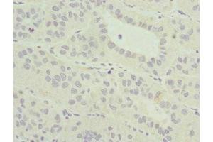 Immunohistochemistry of paraffin-embedded human liver cancer using ABIN7165022 at dilution of 1:100 (AF9 antibody  (AA 1-150))