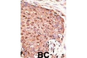 Formalin-fixed and paraffin-embedded human cancer tissue reacted with the primary antibody, which was peroxidase-conjugated to the secondary antibody, followed by AEC staining. (ZMIZ1 antibody  (C-Term))