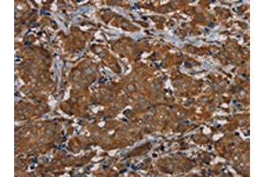 The image on the left is immunohistochemistry of paraffin-embedded Human breast cancer tissue using ABIN7191878(PIK3CD Antibody) at dilution 1/20, on the right is treated with synthetic peptide. (PIK3CD antibody)
