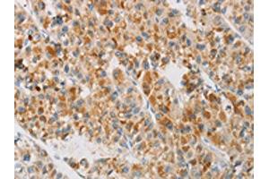 The image on the left is immunohistochemistry of paraffin-embedded Human liver cancer tissue using ABIN7130419(NGB Antibody) at dilution 1/20, on the right is treated with fusion protein. (Neuroglobin antibody)