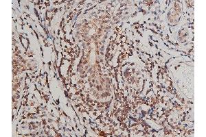ABIN6267415 at 1/200 staining human breast cancer tissue sections by IHC-P. (FLT1 antibody  (pTyr1213))