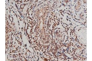 ABIN6267415 at 1/200 staining human breast cancer tissue sections by IHC-P. (FLT1 antibody  (pTyr1213))