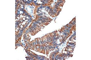 Immunohistochemistry of paraffin-embedded human colon carcinoma using GP Rabbit mAb (ABIN1682863, ABIN3017875, ABIN3017876 and ABIN7101532) at dilution of 1:100 (40x lens). (GPA33 antibody)