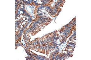 Immunohistochemistry of paraffin-embedded human colon carcinoma using GP Rabbit mAb (ABIN1682863, ABIN3017875, ABIN3017876 and ABIN7101532) at dilution of 1:100 (40x lens).