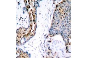 Immunohistochemistry of paraffin-embedded Human breast carcinoma using Phospho-Estrogen Receptor alpha(S118) Polyclonal Antibody (Estrogen Receptor alpha antibody  (pSer118))