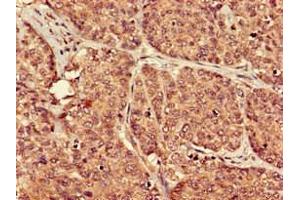 Immunohistochemistry of paraffin-embedded human ovarian cancer using ABIN7164854 at dilution of 1:100 (PTGER3 antibody  (AA 1-49))