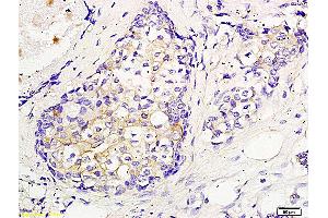 Formalin-fixed and paraffin embedded human breast cancer labeled with Anti CEP55 Polyclonal Antibody, Unconjugated (ABIN872963) followed by conjugation to the secondary antibody and DAB staining