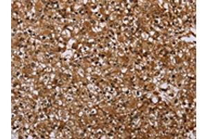 The image on the left is immunohistochemistry of paraffin-embedded Human prostate cancer tissue using ABIN7191451(MFF Antibody) at dilution 1/25, on the right is treated with synthetic peptide. (MFF antibody)
