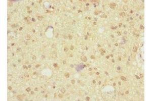 Immunohistochemistry of paraffin-embedded human glioma using ABIN7161221 at dilution of 1:100 (Neurexin 3 antibody  (AA 1584-1643))