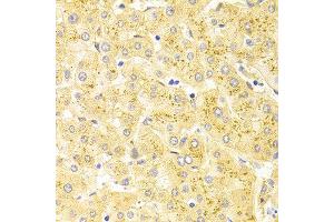 Immunohistochemistry of paraffin-embedded human liver injury using WT1 antibody at dilution of 1:100 (x400 lens). (WT1 antibody)