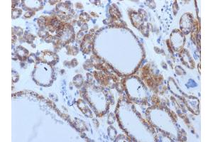 Formalin-fixed, paraffin-embedded human Thyroid Carcinoma stained with TSHRB Monoclonal Antibody (TSHRB/1405). (TSH receptor antibody)