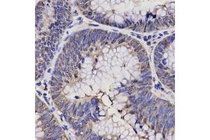 Immunohistochemistry of paraffin-embedded human rectal cancer using NPPA antibody at dilution of 1:200 (x400 lens).