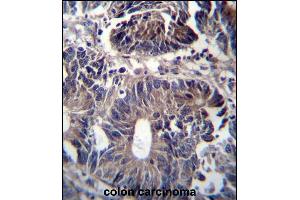ZFYVE19 Antibody (C-term) (ABIN656951 and ABIN2846138) immunohistochemistry analysis in formalin fixed and paraffin embedded human colon carcinoma followed by peroxidase conjugation of the secondary antibody and DAB staining. (ZFYVE19 antibody  (C-Term))