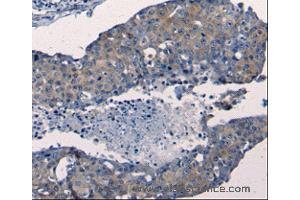 Immunohistochemistry of Human breast cancer using FGF2 Polyclonal Antibody at dilution of 1:50 (FGF2 antibody)