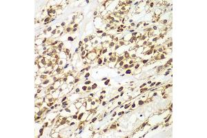 Immunohistochemistry of paraffin-embedded human kidney cancer using SMAD9 antibody (ABIN5975592) at dilution of 1/100 (40x lens). (SMAD9 antibody)