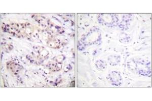 Immunohistochemistry analysis of paraffin-embedded human breast carcinoma tissue, using PKC alpha (Ab-638) Antibody. (PKC alpha antibody  (AA 606-655))