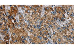 Immunohistochemistry of paraffin-embedded Human liver cancer using PDSS2 Polyclonal Antibody at dilution of 1:30 (PDSS2 antibody)
