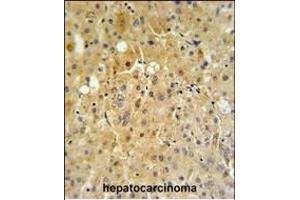 P450R Antibody (Center) (ABIN390416 and ABIN2840804) IHC analysis in formalin fixed and paraffin embedded human hepatocarcinoma tissue followed by peroxidase conjugation of the secondary antibody and DAB staining. (POR antibody  (AA 462-488))