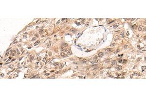 Immunohistochemistry of paraffin-embedded Human esophagus cancer tissue using KNOP1 Polyclonal Antibody at dilution of 1:85(x200) (KNOP1 antibody)