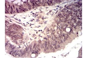 Immunohistochemical analysis of paraffin-embedded esophageal cancer tissues using HTRA2 mouse mAb with DAB staining.