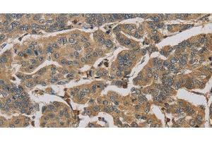 Immunohistochemistry of paraffin-embedded Human breast cancer tissue using TBXAS1 Polyclonal Antibody at dilution 1:30 (TBXAS1 antibody)