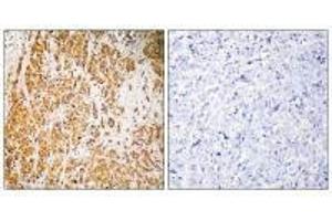 Immunohistochemistry analysis of paraffin-embedded human breast carcinoma tissue, using ZSCAN22 antibody. (ZSCAN22 antibody)