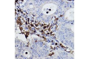 Immunohistochemistry of paraffin-embedded human colon carcinoma using NCF4/p40-phox Rabbit mAb (ABIN7268900) at dilution of 1:100 (40x lens). (NCF4 antibody)
