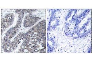 Immunohistochemical analysis of paraffin-embedded human breast carcinoma tissue, using Pyk2 (Ab-402) antibody (E021209). (PTK2B antibody)
