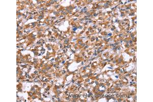 Immunohistochemistry of Human gastric cancer using GPC6 Polyclonal Antibody at dilution of 1:40 (Glypican 6 antibody)