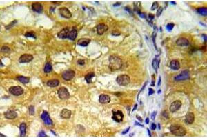 Immunohistochemistry (IHC) analyzes of BRCA1 pAb in paraffin-embedded human lung carcinoma tissue. (BRCA1 antibody)