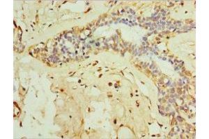 Immunohistochemistry of paraffin-embedded human breast cancer using ABIN7156612 at dilution of 1:100 (IL28B antibody  (AA 22-196))